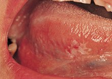 hpv throat cancer symptoms