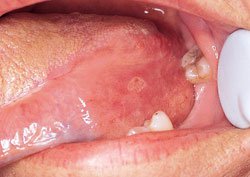 MOUTH SORES AND SPOTS Specialized Dentistry